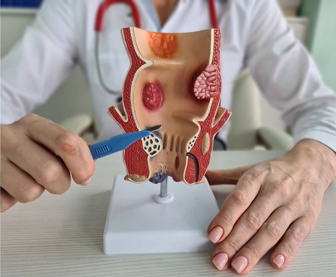 Is There Any Medicine for Anal Fistula? Here is What You Need to Know