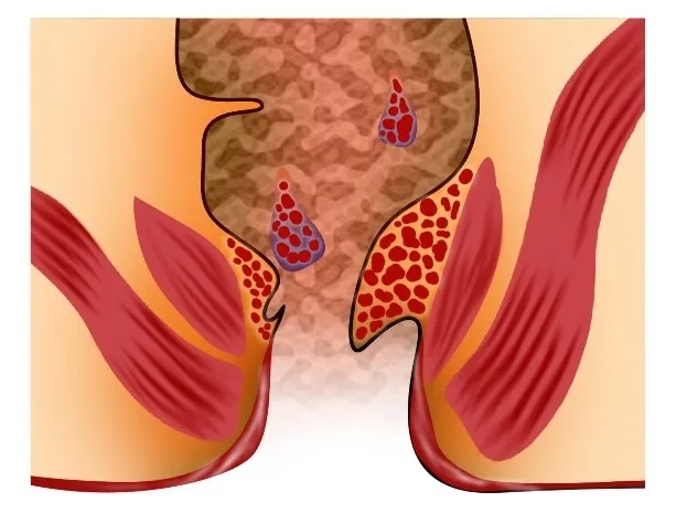 ਗਰੇਡ 1 ਦੀ ਅੰਦਰੂਨੀ ਬਵਾਸੀਰ – ਲੱਛਣ, ਕਾਰਨ ਅਤੇ ਇਲਾਜ