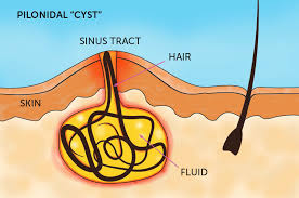 Pilonidal Sinus