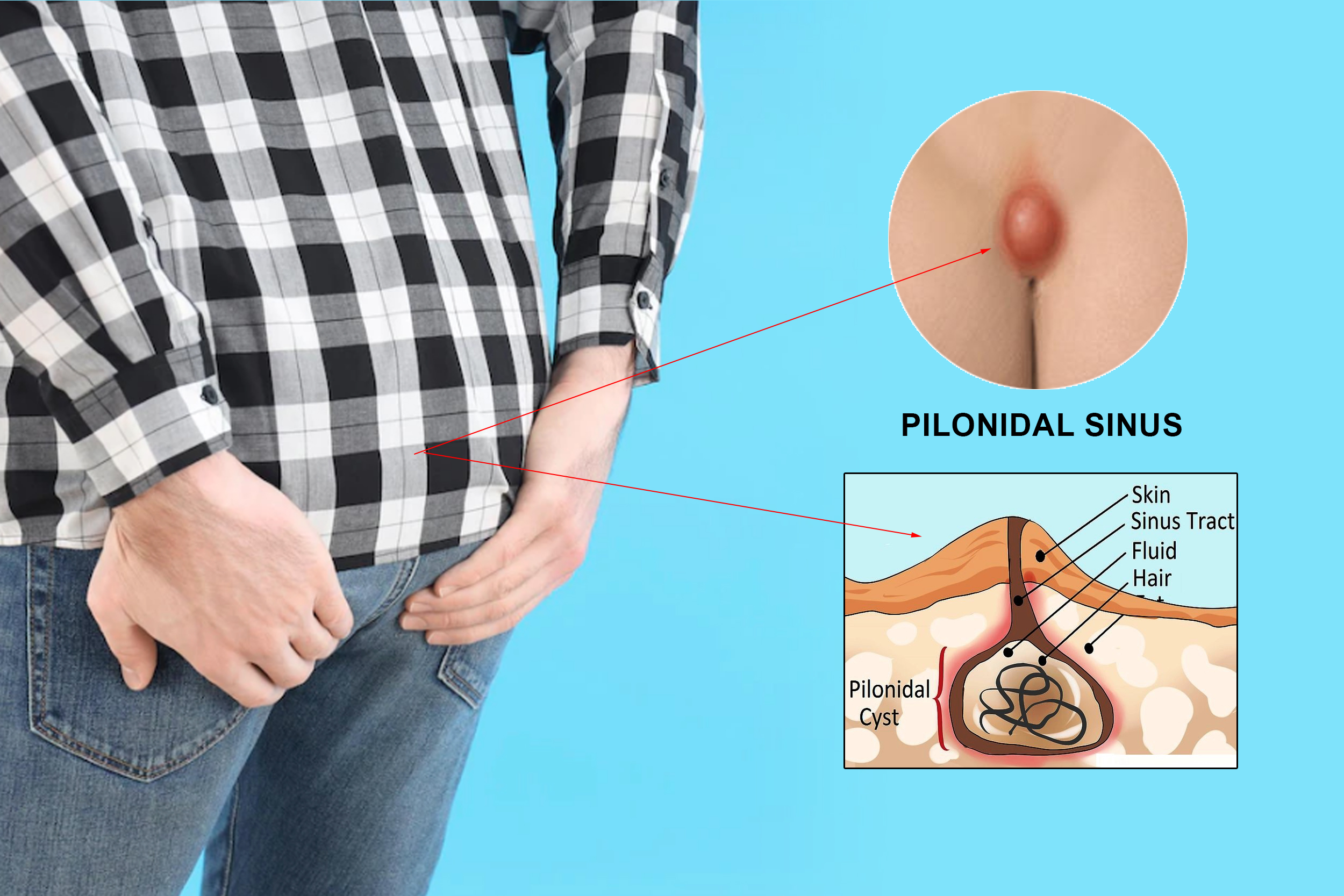 Understanding Pilonidal Sinus: Causes, Symptoms, and Advanced Laser Treatment (VALAPS)