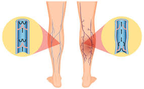 Varicose Veins