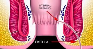 Anorectal Abscess Diagram
